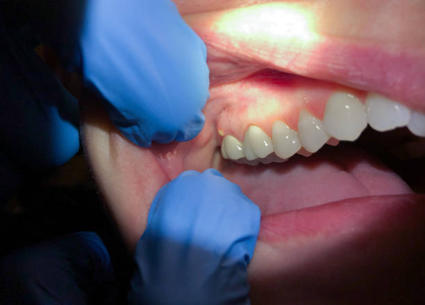 Best Knocked-Out Tooth Emergency  in South Dennis, MA